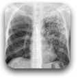 Tuberculosis