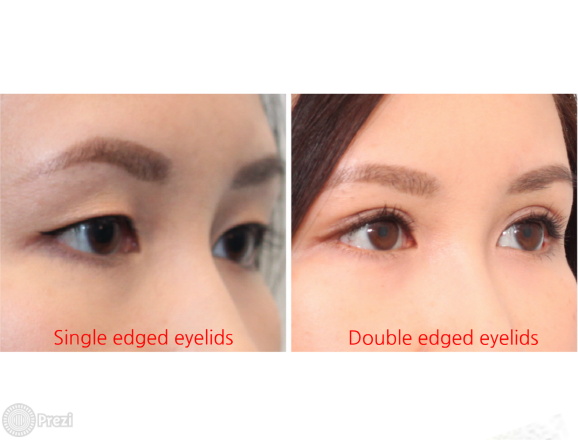 double edged eyelid